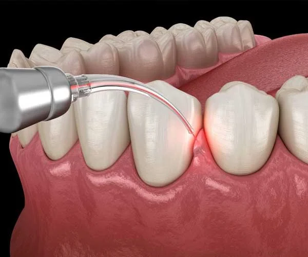 gum treatment in noida