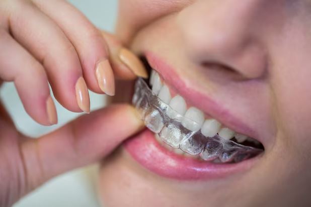 How Teeth Aligners Are Enhancing the Results of Smile Makeovers in Noida’s Top Clinics