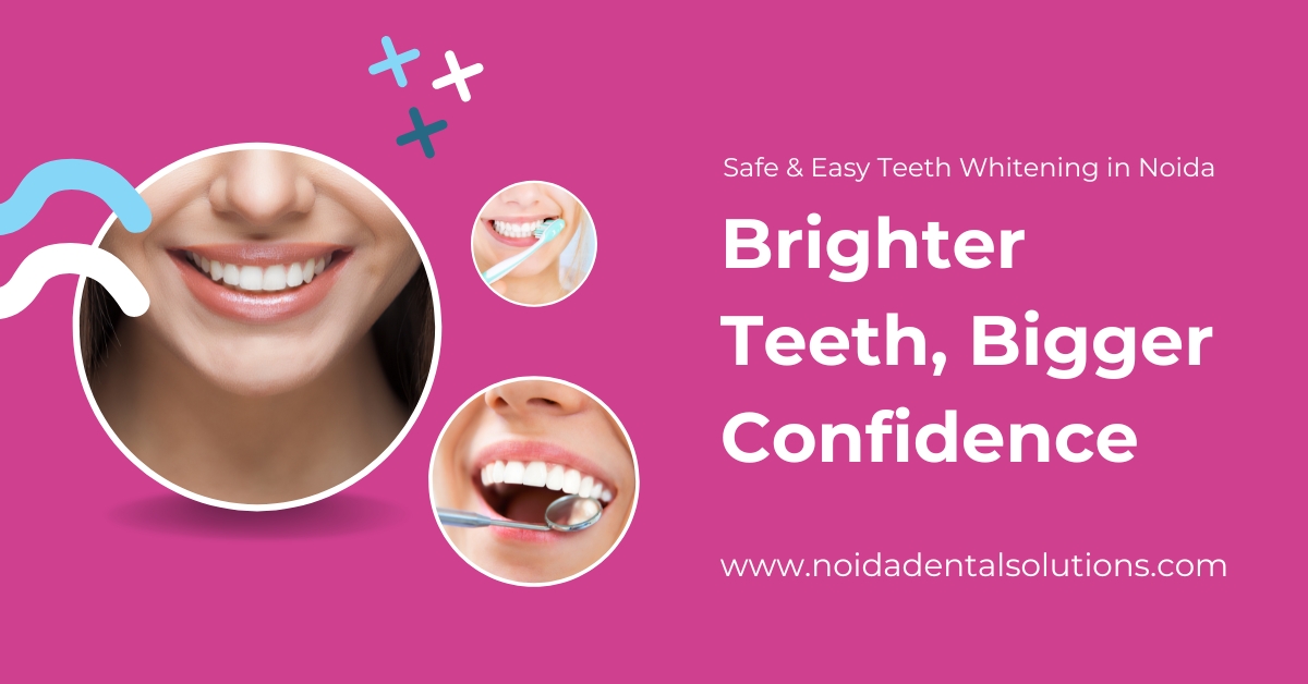 Whiten Your Teeth Before That Big Interview or Wedding – Teeth Whitening in Noida