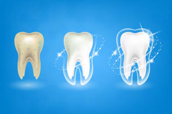 How far can teeth whitening go? Duration, Factors & Maintenance Tips