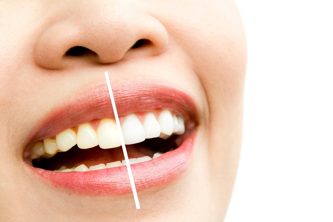 Teeth Whitening in Noida: Restore Your Bright Smile Safely and Effectively