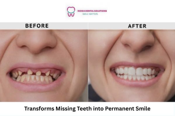 How a Dental Implant Clinic Transforms Missing Teeth into Permanent Smiles