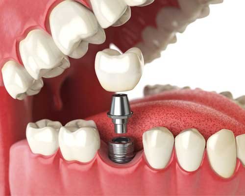 Dental Implant Treatment in noida