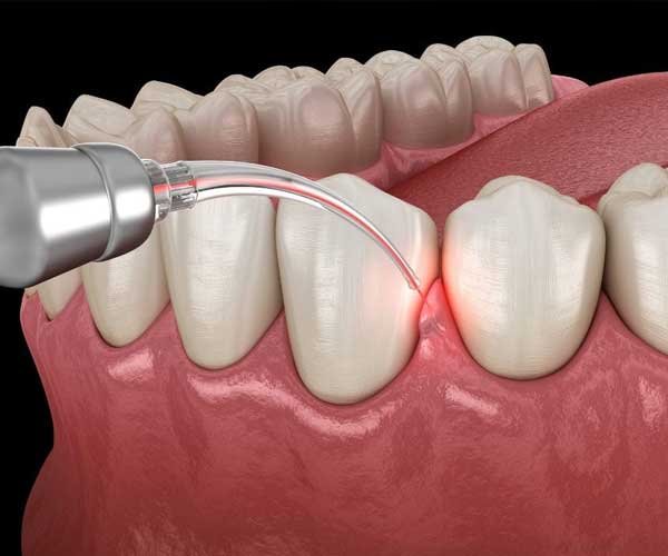gum treatment noida dental