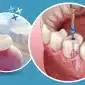 root canal treatment in Noida