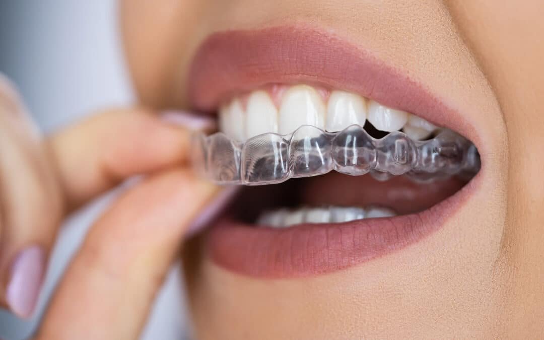 teeth Aligners treatment in noida
