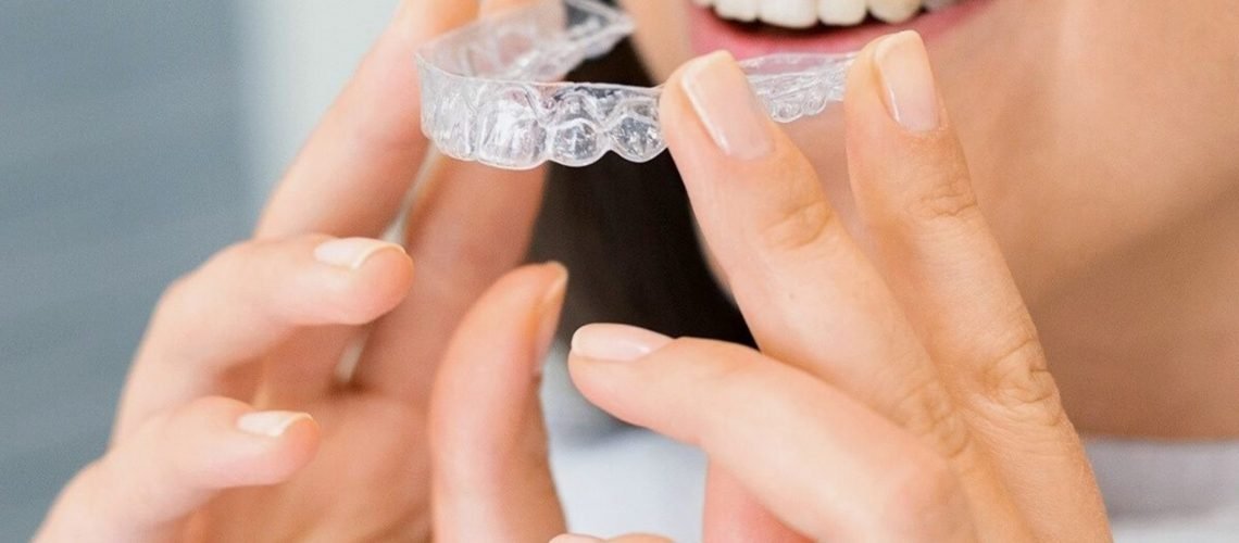 teeth Aligners treatment in noida